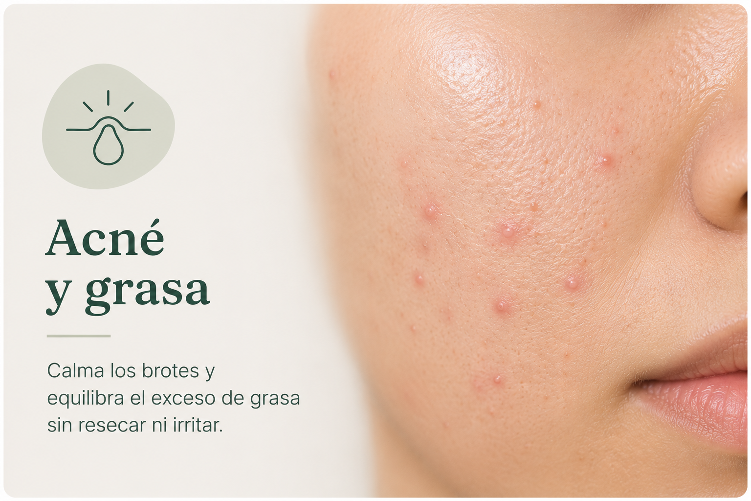 Acn&eacute; y grasa: calma los brotes y equilibra el exceso de grasa sin resecar ni irritar